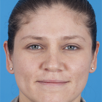 25-34 year old woman treated with Rhinoplasty before 3159477