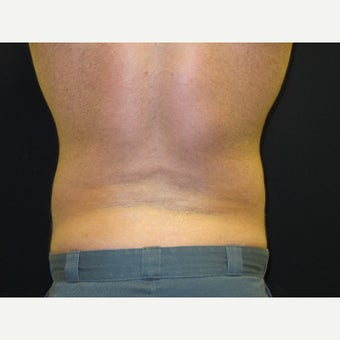 35-44 year old man treated with CoolSculpting 1770694