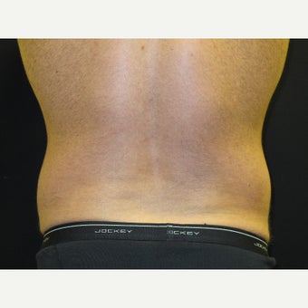 35-44 year old man treated with CoolSculpting 1770694