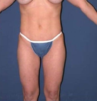 35-44 year old woman treated with SAFELipo after 3126343