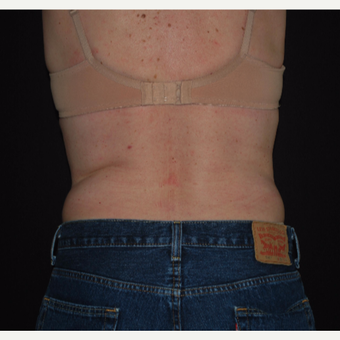 45-54 year old woman treated with Vanquish ME after 3500337