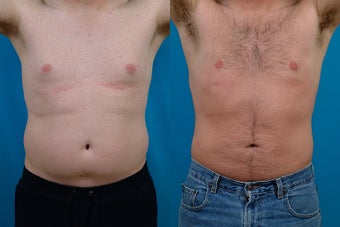 40-year-old man treated with Male Breast Reduction. before 3299573