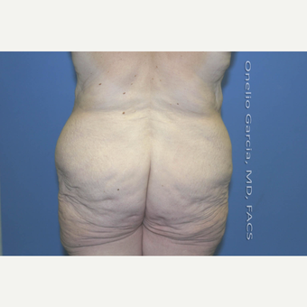 45-54 year old woman treated with Body Lift-Circumferential "Belt" lipectomy + Vaser Liposuction before 3041536