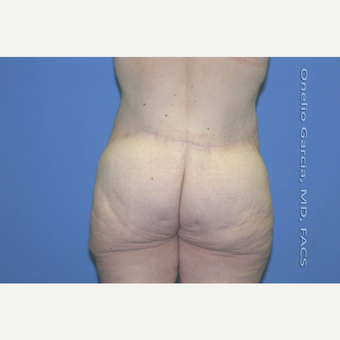 45-54 year old woman treated with Body Lift-Circumferential "Belt" lipectomy + Vaser Liposuction after 3041536