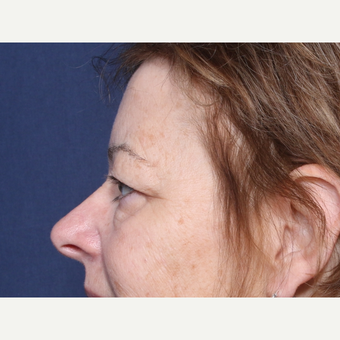 55-64 year old woman treated with Eyelid Surgery (view 2 of 2) before 3180538