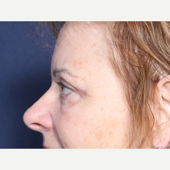 55-64 year old woman treated with Eyelid Surgery (view 2 of 2) after 3180538