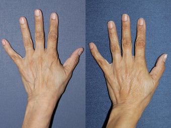 Sclerotherapy Before and After before 1033925