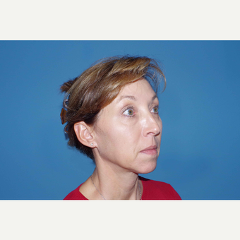 45-54 year old woman treated with ArteFill after 3630167