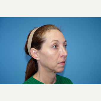 45-54 year old woman treated with ArteFill before 3630167