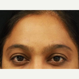 38 year old female treated with Botox for frown lines after 3072122