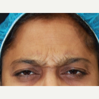 38 year old female treated with Botox for frown lines before 3072122