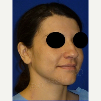 18-24 year old woman treated with Rhinoplasty before 3356286