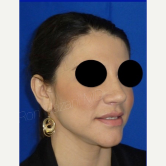 18-24 year old woman treated with Rhinoplasty after 3356286