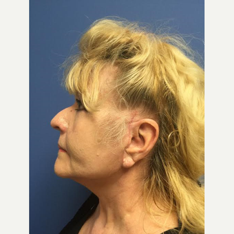 65-74 year old woman treated with Facelift after 3688766