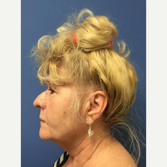 65-74 year old woman treated with Facelift before 3688766
