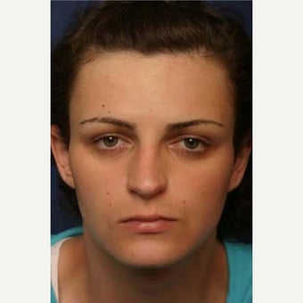 25-34 year old woman treated with Facial Feminization Surgery before 1790498