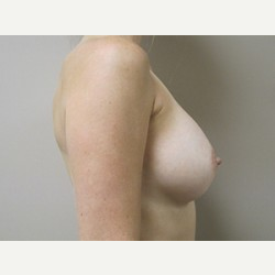 Breast Implants after 3373623