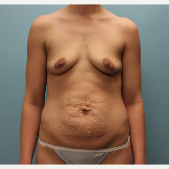 25-34 year old woman treated with Mommy Makeover before 3577096