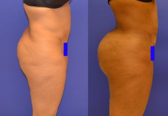 Brazillian Butt Lift and Revision Liposuction (from other doctor) before 1184175