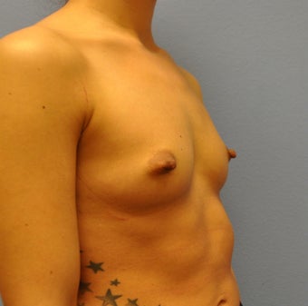 Breast Augmentation, Breast Implants 1205571