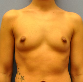 Breast Augmentation, Breast Implants before 1205571