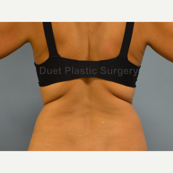 45-54 year old woman treated with Liposuction before 3367927
