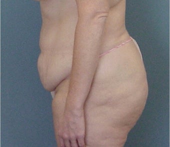 35-44 year old woman treated with Tummy Tuck before 3289657