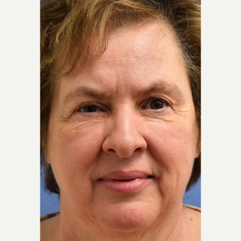 55-64 year old woman treated with Laser Treatment before 3187480