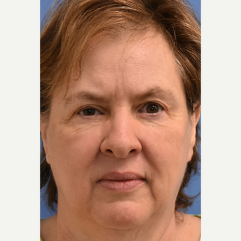 55-64 year old woman treated with Laser Treatment after 3187480