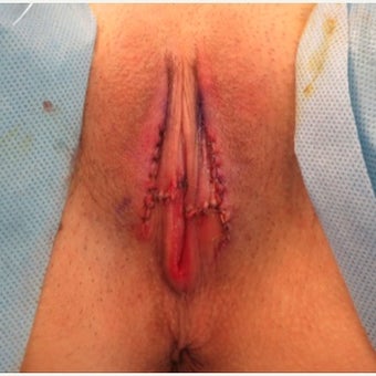 25-34 year old woman treated with Vaginal Rejuvenation after 2121737