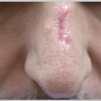 45-54 year old man treated with ProFractional Laser before 2716086