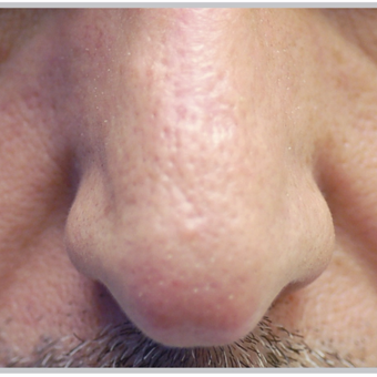 45-54 year old man treated with ProFractional Laser after 2716086