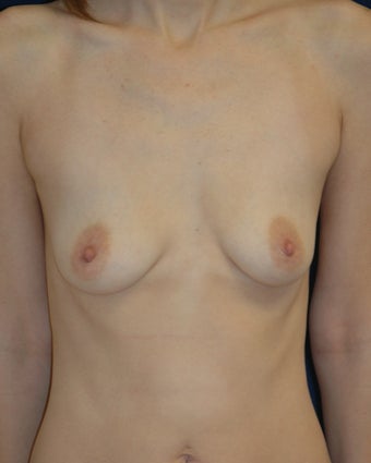 Breast Augmentation before 1458898