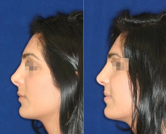 Nose Surgery before 1430789