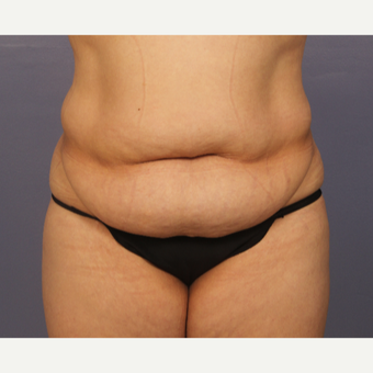 35-44 year old woman treated with Drainless Tummy Tuck before 3500913