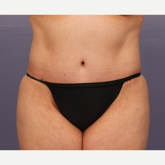 35-44 year old woman treated with Drainless Tummy Tuck after 3500913