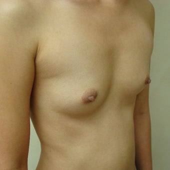 25-34 year old woman treated with Mentor Breast Implants before 2596179