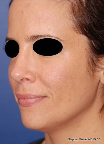 25-34 year old woman treated with Rhinoplasty after 3624180