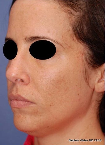 25-34 year old woman treated with Rhinoplasty before 3624180