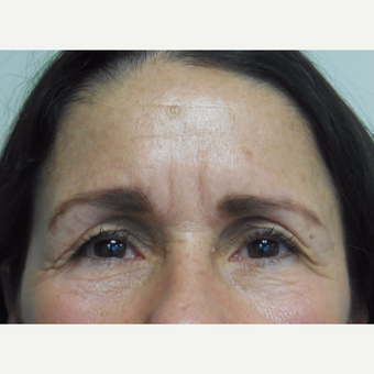 55 year old woman treated with Botox before 3737989