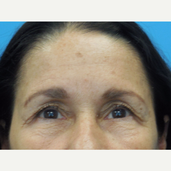 55 year old woman treated with Botox after 3737989