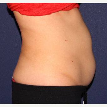 25-34 year old woman treated with CoolSculpting before 3138861