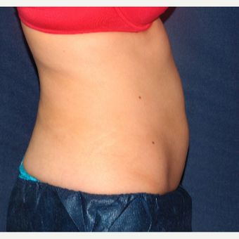 25-34 year old woman treated with CoolSculpting after 3138861