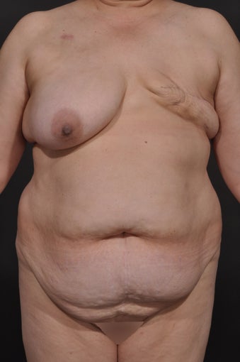 Breast Reconstruction before 927733