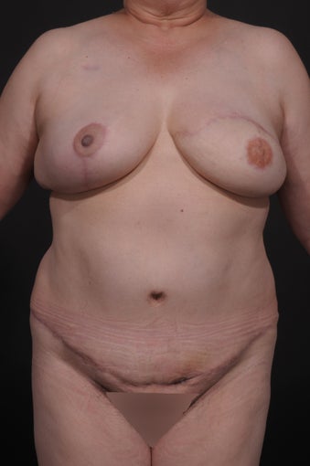 Breast Reconstruction after 927733