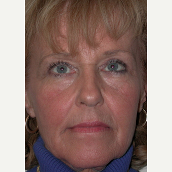 45-54 year old woman treated with Facelift before 3747655