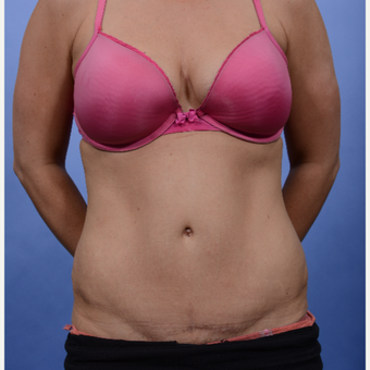 Tummy Tuck after 3052351