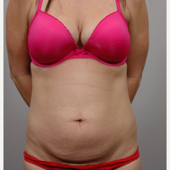Tummy Tuck before 3052351