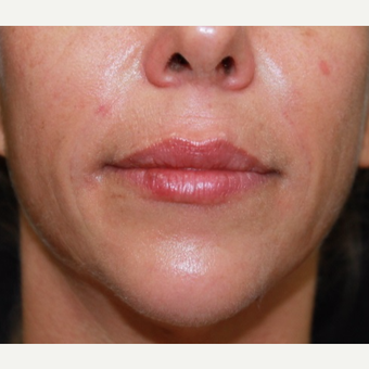 41 year old woman treated with Belotero for lip augmentation. after 3000833