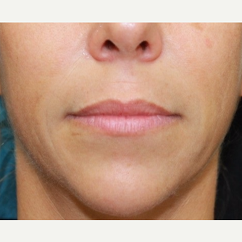41 year old woman treated with Belotero for lip augmentation. before 3000833